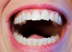 5 גורמים שמשפיעים על המחיר של השתלת שיניים
